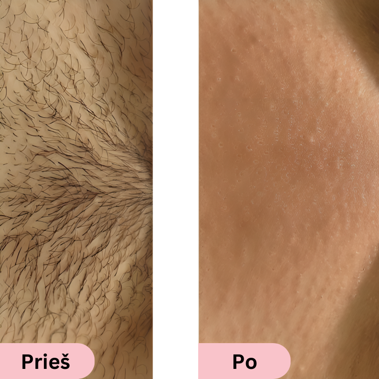Glowie™ IPL фотоепилатор – Уред за премахване на окосмяване